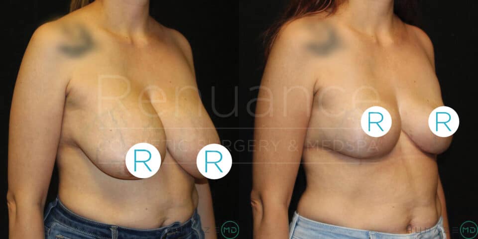 The image shows a side-by-side comparison of a woman's upper body before and after a cosmetic breast surgery. In the left view, the woman has larger, sagging breasts, while in the right view, the breasts appear more lifted and firm. Both images have circular blue labels with the letter "R" covering the areolas. The woman is wearing light blue jeans, and the background is black. The text "Rejuance Cosmetic Surgery & Medspa" is faintly visible across the center of