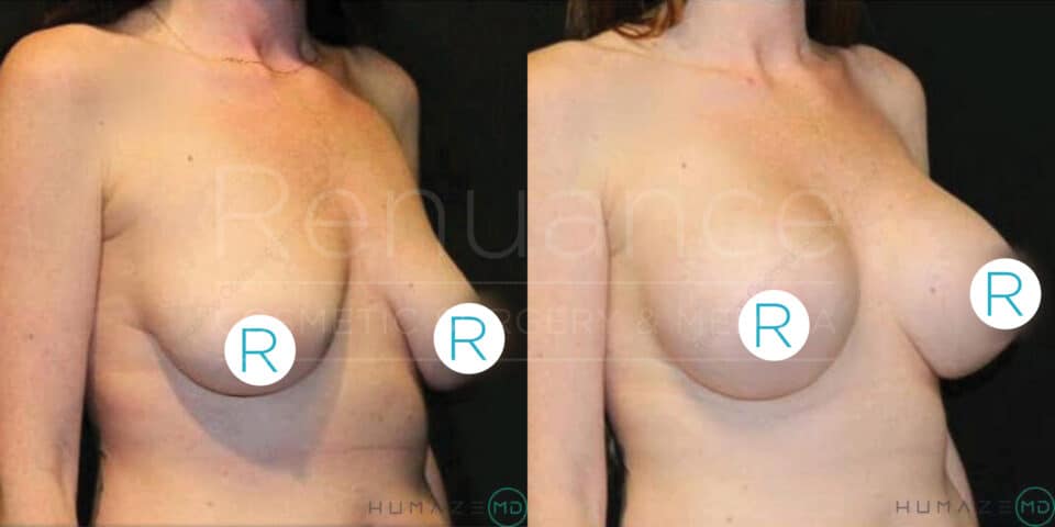 Side-by-side comparison of a woman shown from the shoulders to the waist, before and after a breast augmentation surgery. The left image displays the pre-surgery state, while the right image shows the post-surgery results. Both images have a circular label with the letter "R". The background is dark and the woman is not wearing a top or bra.