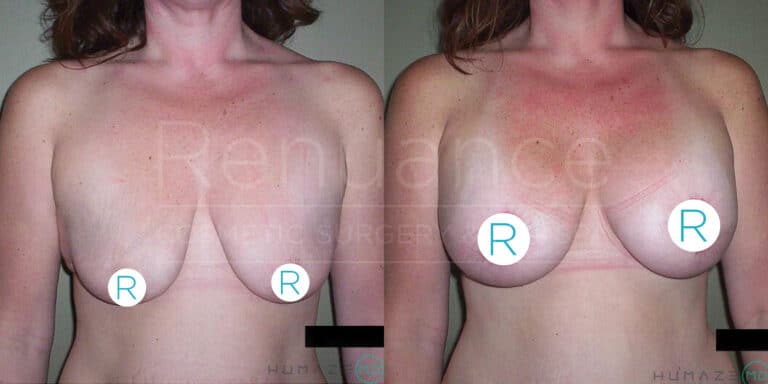 Side-by-side comparison of two photos showing the results of a breast lift surgery. The left image shows a woman with sagging breasts before the surgery, while the right image shows the same woman with uplifted, firmer breasts after the surgery. The images are labeled with "R" markers to indicate the right breast for reference.