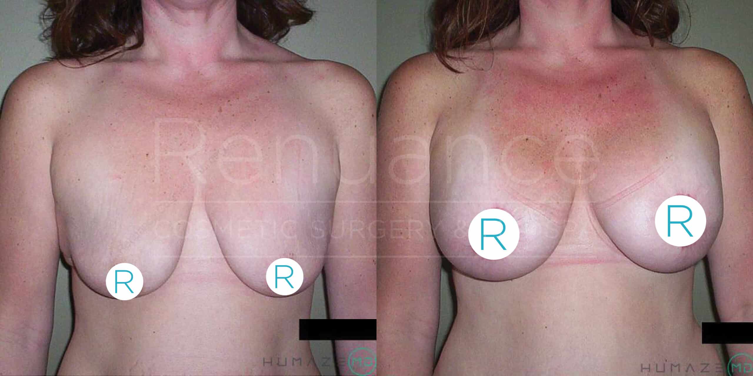 Side-by-side comparison of two photos showing the results of a breast lift surgery. The left image shows a woman with sagging breasts before the surgery, while the right image shows the same woman with uplifted, firmer breasts after the surgery. The images are labeled with "R" markers to indicate the right breast for reference.