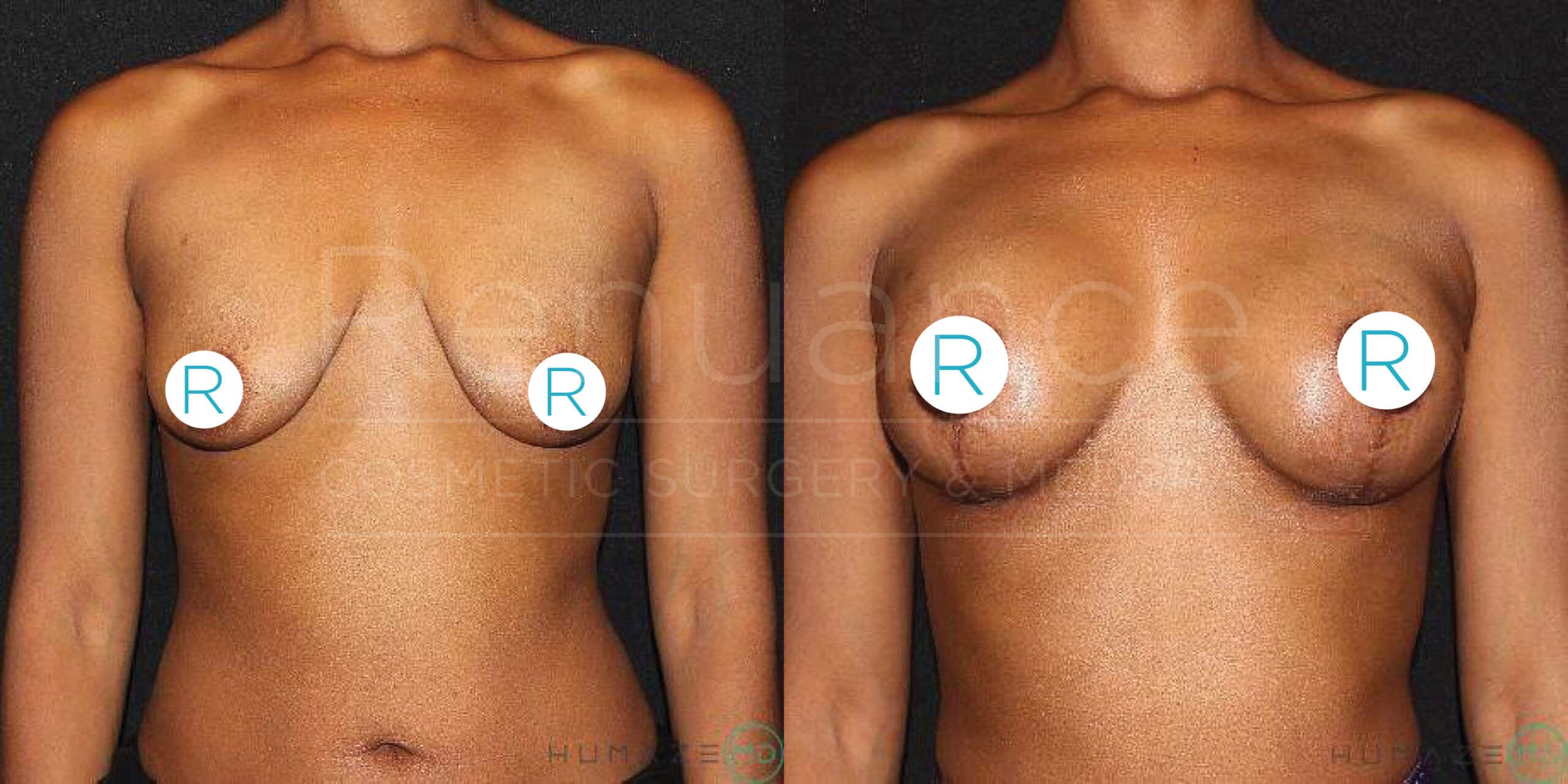 Side-by-side comparison of a person's torso before and after undergoing breast augmentation surgery. The left side shows the body before surgery, while the right side shows the body after the procedure, with visibly fuller and lifted breasts. Each image has circular labels with the letter "R" covering part of the chest area.
