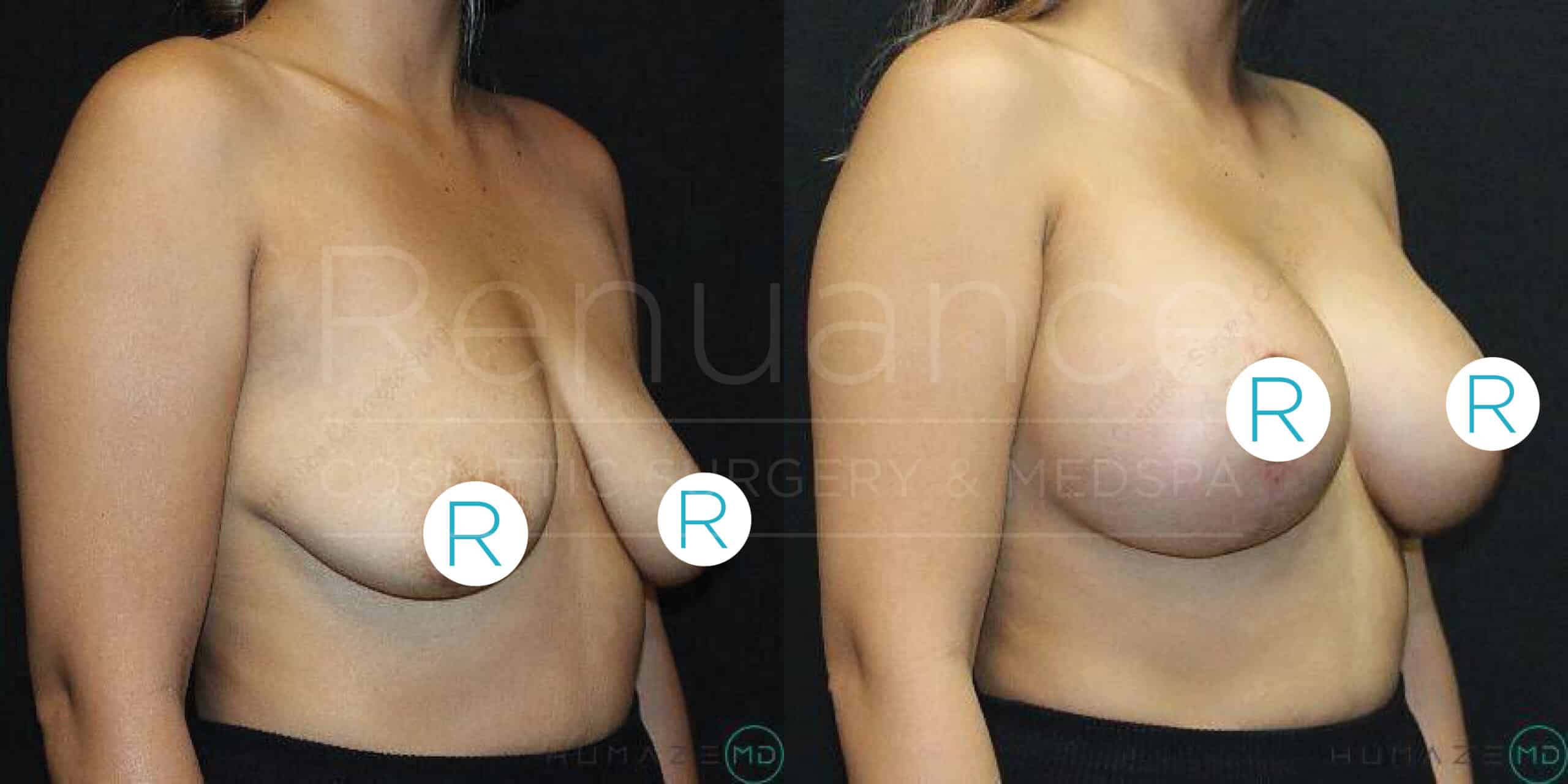 Side-by-side comparison of a woman's torso, showing the results of a breast augmentation surgery. The left image displays the "before" condition, and the right image shows the "after" condition. Each image has a circular icon with the letter "R" placed over each breast. The background is black.
