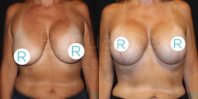 Before and after images showing the torso of a person who underwent breast augmentation surgery. The left image displays the person before surgery with noticeably sagging breasts, while the right image shows the person after surgery with lifted and fuller breasts. The background is dark, emphasizing the changes in the subject's torso, with noticeable tan lines present in both images. Each breast is marked with a white circle containing the letter "R" in blue.