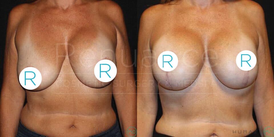 Before and after images showing the torso of a person who underwent breast augmentation surgery. The left image displays the person before surgery with noticeably sagging breasts, while the right image shows the person after surgery with lifted and fuller breasts. The background is dark, emphasizing the changes in the subject's torso, with noticeable tan lines present in both images. Each breast is marked with a white circle containing the letter "R" in blue.