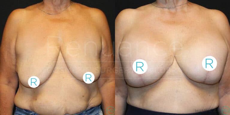 A side-by-side comparison of a person's chest before and after breast augmentation surgery. The left image shows the chest before the procedure, while the right image shows the chest after the procedure, with visibly fuller and lifted breasts. Both images have the letters "R" on the chest area, presumably to indicate "right" side. The person's face is not visible in either image.