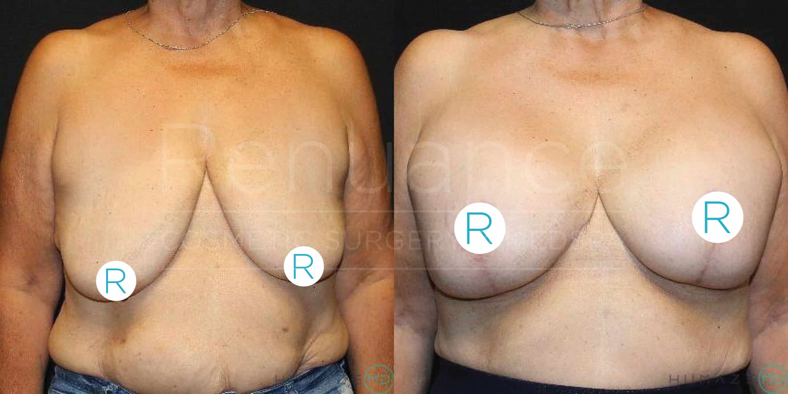 A side-by-side comparison of a person's chest before and after breast augmentation surgery. The left image shows the chest before the procedure, while the right image shows the chest after the procedure, with visibly fuller and lifted breasts. Both images have the letters "R" on the chest area, presumably to indicate "right" side. The person's face is not visible in either image.