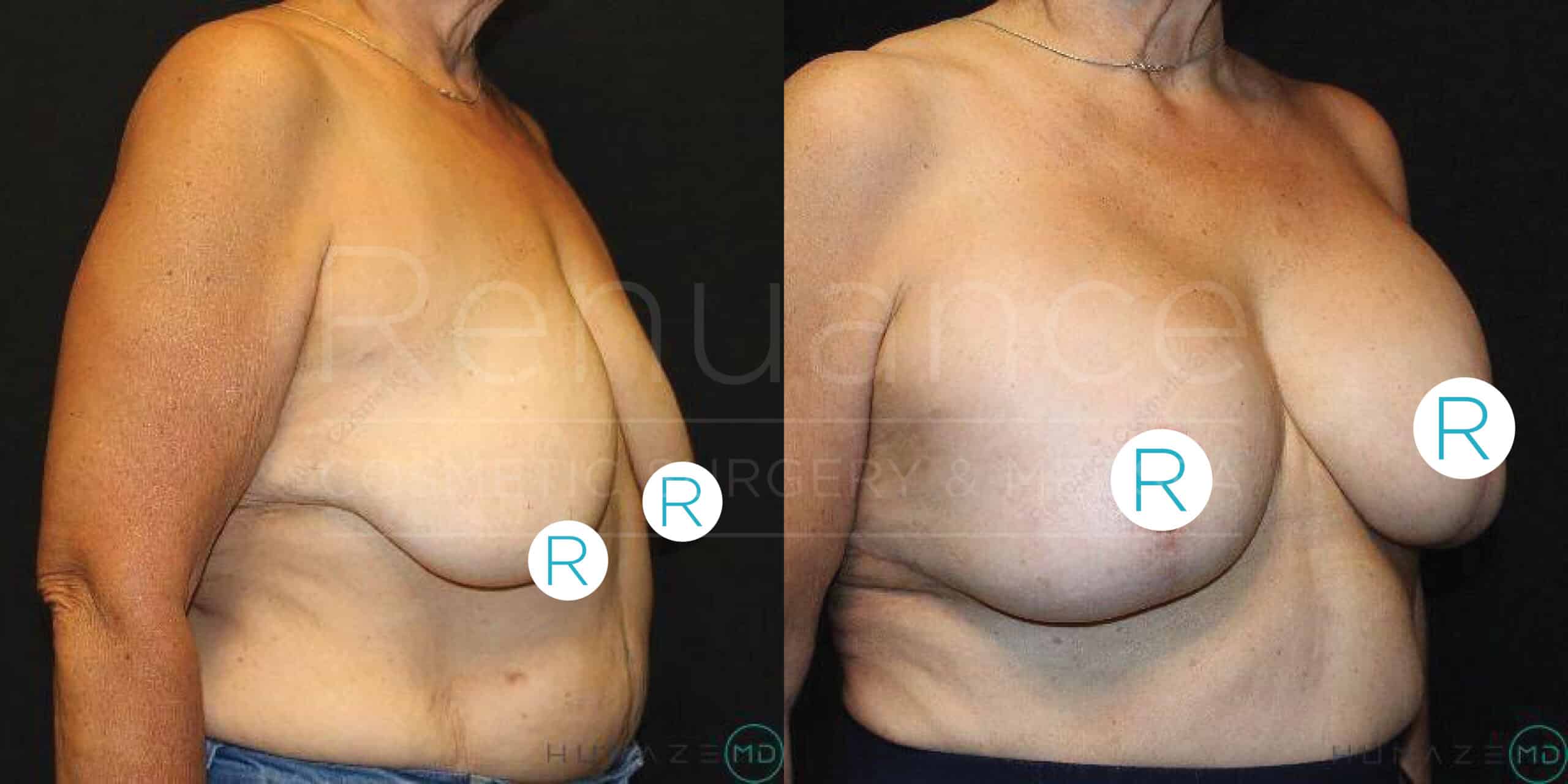 Two side-by-side images show the same individual from the torso up. The left image is a before photo, showing the person with sagging breasts and loose skin. The right image is an after photo, depicting the person post-surgery with firm, lifted breasts. Both images have a watermark that says "Renuance." Circular stickers labeled "R" cover the nipples for obscurity.