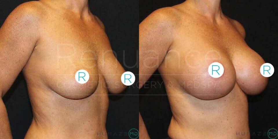 A before-and-after image showing the results of breast augmentation surgery. The left side of the image displays a person with smaller breasts before surgery, while the right side of the image shows the same person after surgery with larger, fuller breasts. Both images are taken against a black background, and the person's torso is visible without their face shown. Circular labels with the letter "R" are placed over the nipples for privacy.