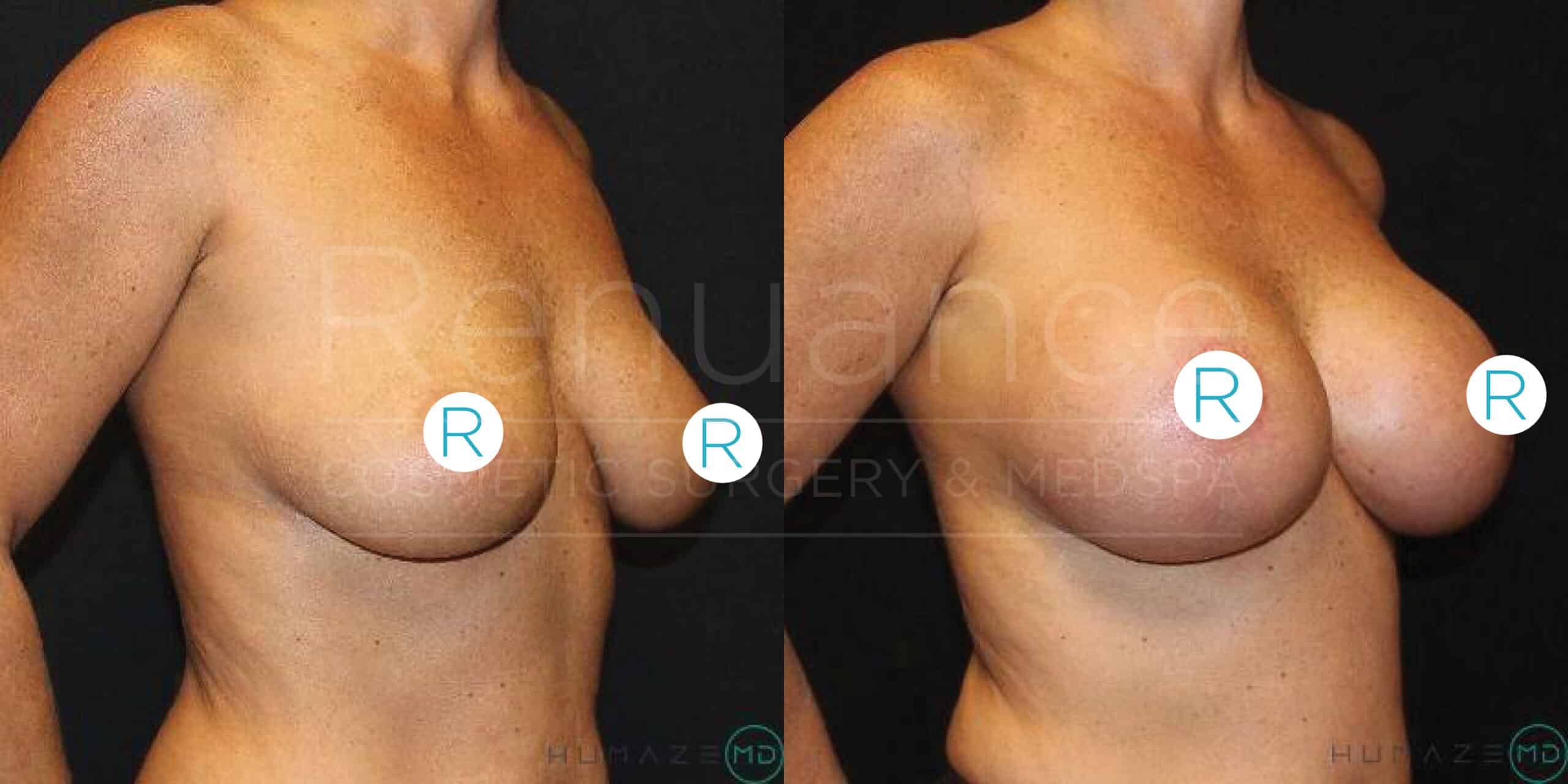 A before-and-after image showing the results of breast augmentation surgery. The left side of the image displays a person with smaller breasts before surgery, while the right side of the image shows the same person after surgery with larger, fuller breasts. Both images are taken against a black background, and the person's torso is visible without their face shown. Circular labels with the letter "R" are placed over the nipples for privacy.