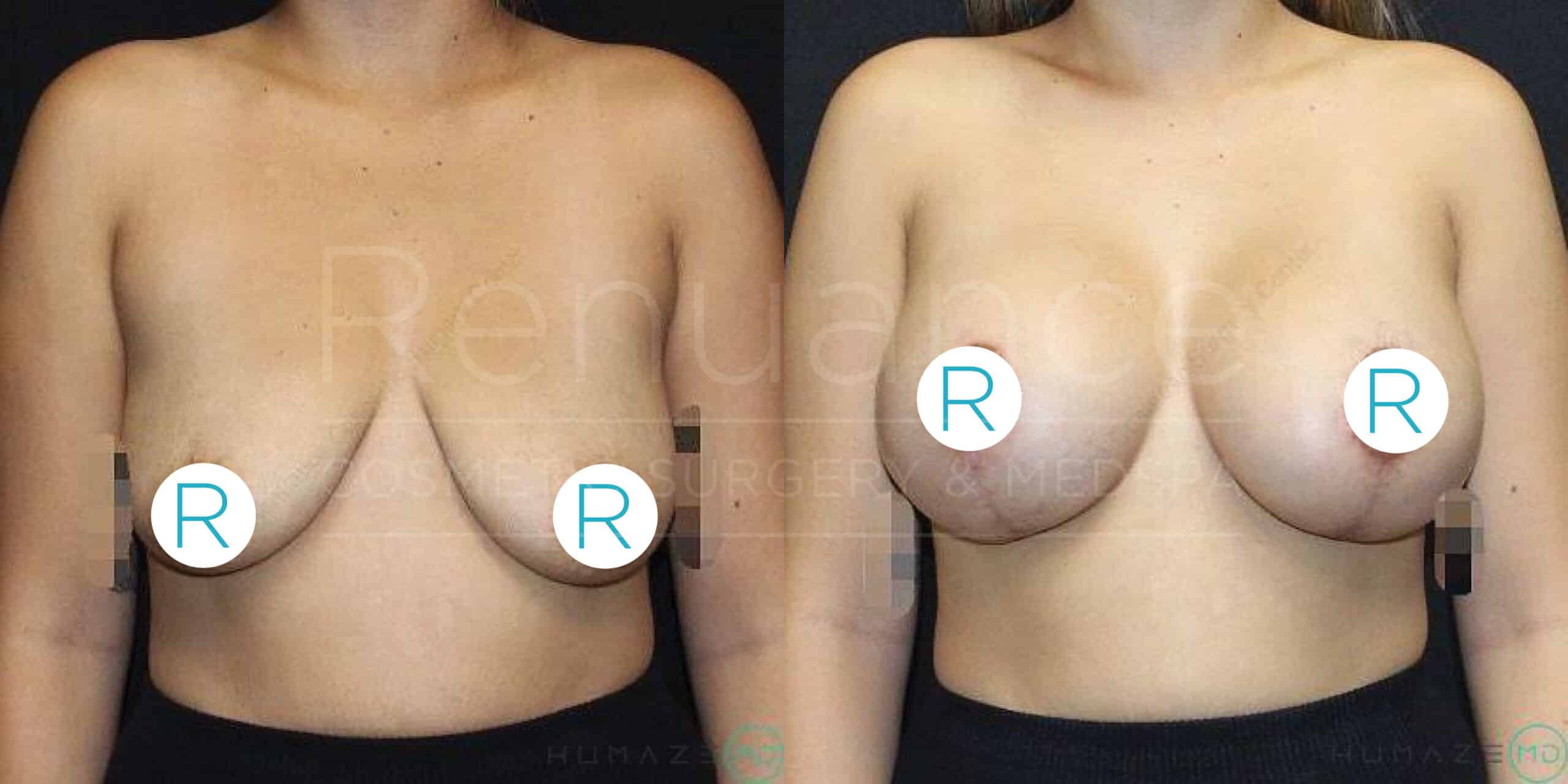 A side-by-side before and after image of a person who has undergone breast enhancement surgery. The person is standing topless and facing the camera in both images. The image on the left shows the person before the surgery, with noticeably smaller breasts. The image on the right shows the results after the surgery, with a significant increase in breast size and lift. The nipples in both images are covered with circular "R" labels for privacy.