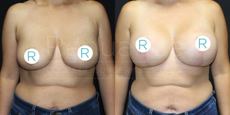 The image shows a side-by-side comparison of a person's torso before and after breast augmentation surgery. Both images include stickers with the letter "R" covering the nipples. In the "before" image on the left, the breasts appear larger and less lifted than in the "after" image on the right, where the breasts appear smaller, more lifted, and symmetrical. The person is wearing jeans in both images.