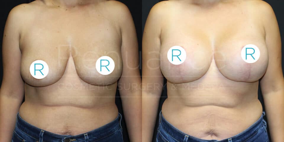 The image shows a side-by-side comparison of a person's torso before and after breast augmentation surgery. Both images include stickers with the letter "R" covering the nipples. In the "before" image on the left, the breasts appear larger and less lifted than in the "after" image on the right, where the breasts appear smaller, more lifted, and symmetrical. The person is wearing jeans in both images.