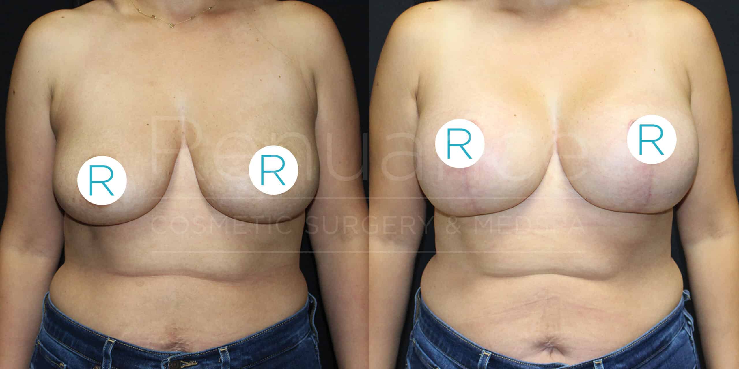 The image shows a side-by-side comparison of a person's torso before and after breast augmentation surgery. Both images include stickers with the letter "R" covering the nipples. In the "before" image on the left, the breasts appear larger and less lifted than in the "after" image on the right, where the breasts appear smaller, more lifted, and symmetrical. The person is wearing jeans in both images.