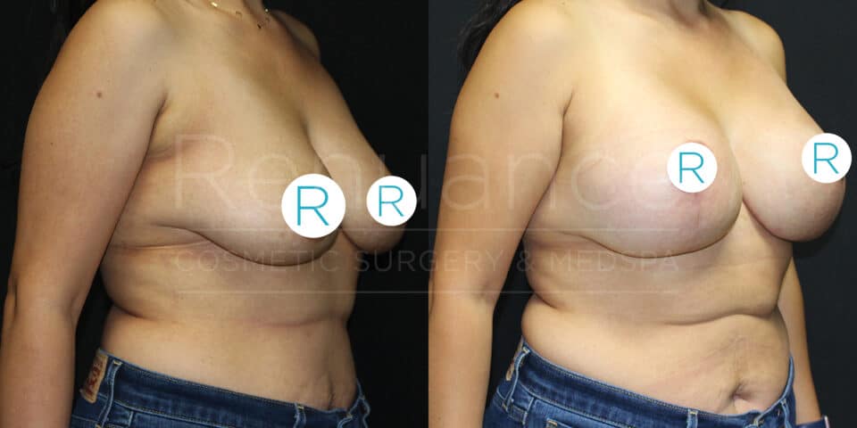 Before and after side-by-side photos showing the result of a cosmetic breast surgery. The left image displays the body prior to the procedure, while the right image shows the same body after the surgery with a noticeable change in breast size and shape. The individual is wearing jeans in both images. The background is black.