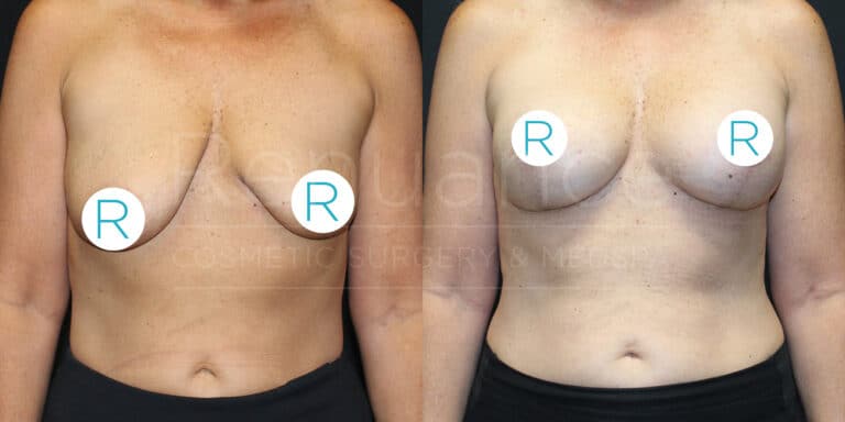 Before and after images of a person's torso showcasing the results of a breast lift surgery. The "before" image on the left shows sagging breasts, and the "after" image on the right shows lifted and firmer breasts. The images have stickers labeled "R" covering the nipple areas.