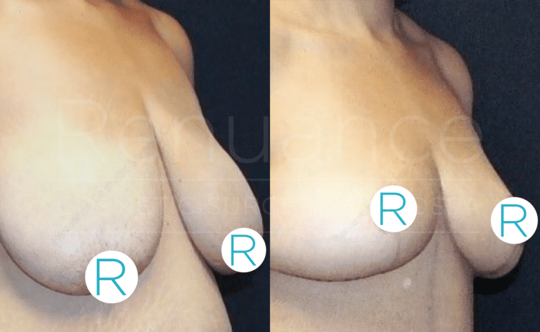 A side-by-side comparison photograph showing the results of a breast augmentation or lift procedure. The left side image shows the person's breasts before the procedure, while the right side image displays the results after the procedure, with visibly lifted and reshaped breasts. The images are labeled with the letter "R" on each breast, signifying "Right."