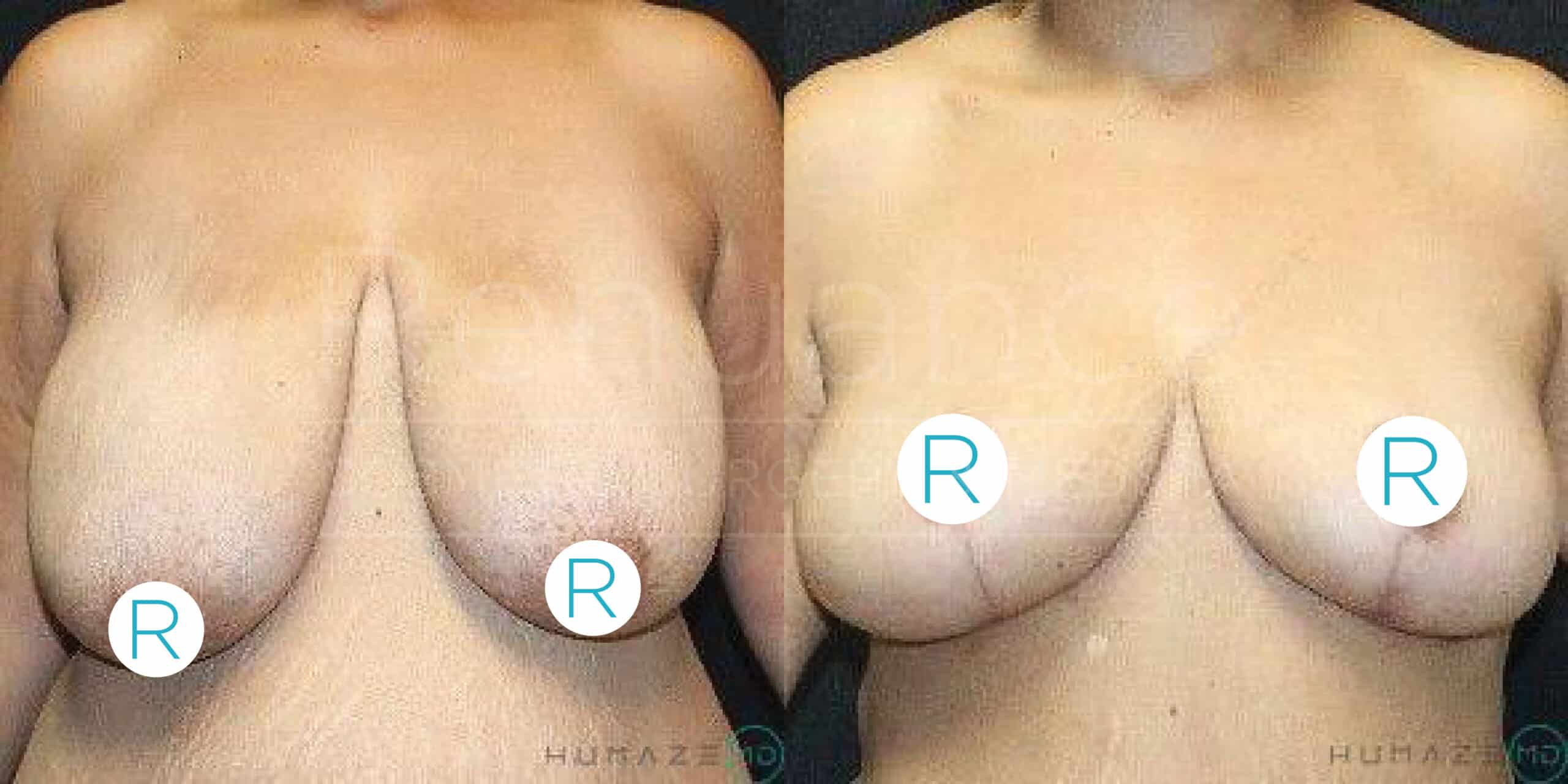 Side-by-side comparison showing two views of a person's chest before and after a breast lift surgery. The left image shows the chest before the procedure, with sagging breasts, and the right image shows the chest after the procedure, with visibly lifted and firmer breasts. Both images have opaque circles labeled "R" covering the nipples to maintain privacy.