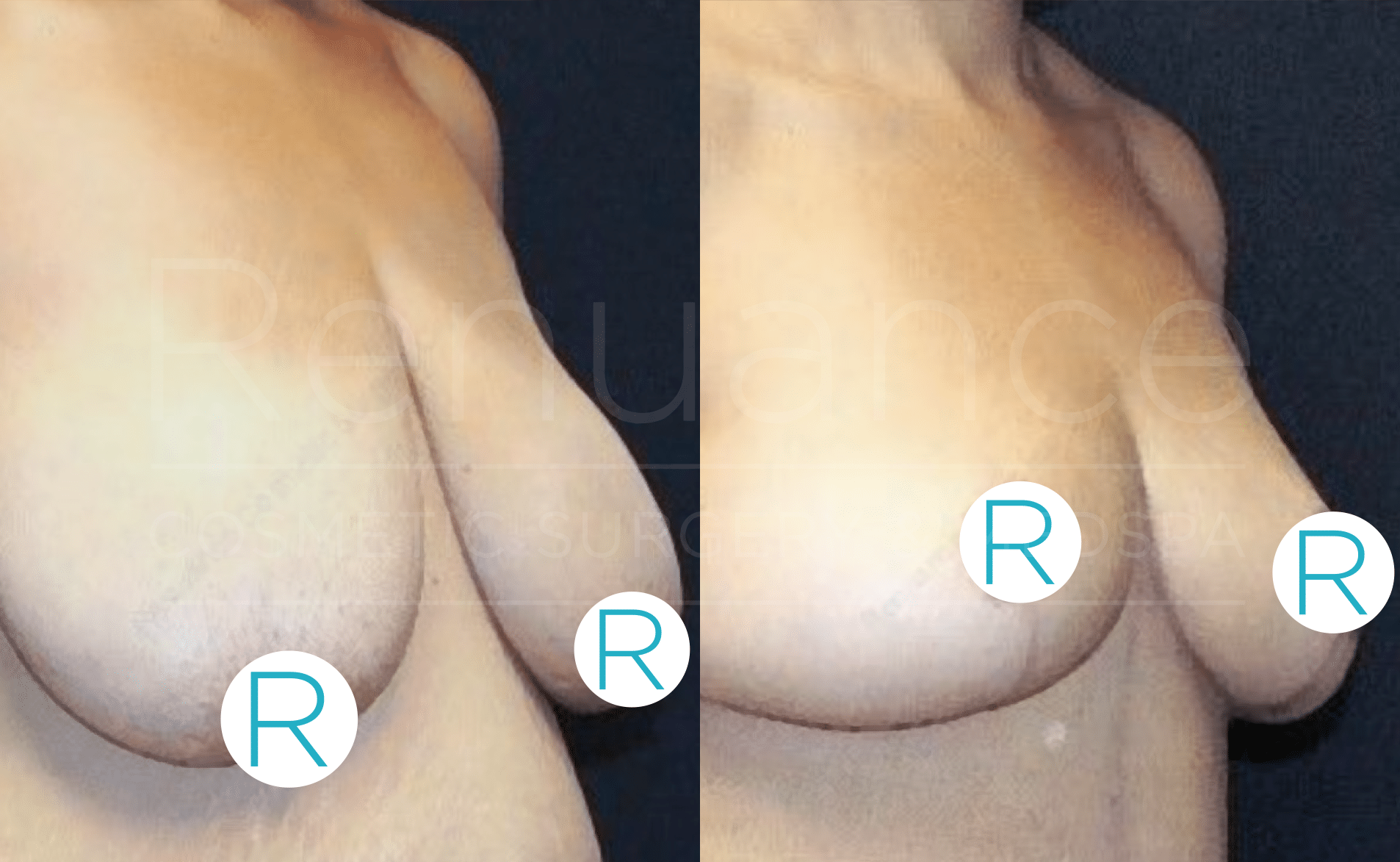 A side-by-side comparison photograph showing the results of a breast augmentation or lift procedure. The left side image shows the person's breasts before the procedure, while the right side image displays the results after the procedure, with visibly lifted and reshaped breasts. The images are labeled with the letter "R" on each breast, signifying "Right."