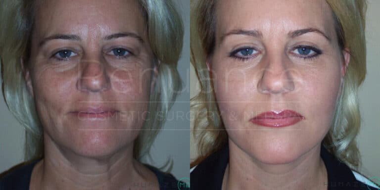 Two side-by-side portraits of the same woman illustrate a "before and after" effect of a cosmetic procedure. In the first image on the left, the woman appears with a more natural complexion and facial wrinkles. In the second image on the right, her skin looks smoother, and her face appears more contoured, with makeup enhancing her features. The background in both images is plain, ensuring focus on the woman's face. The logo "Reflections Center for Cosmetic Surgery & Medspa" is faintly