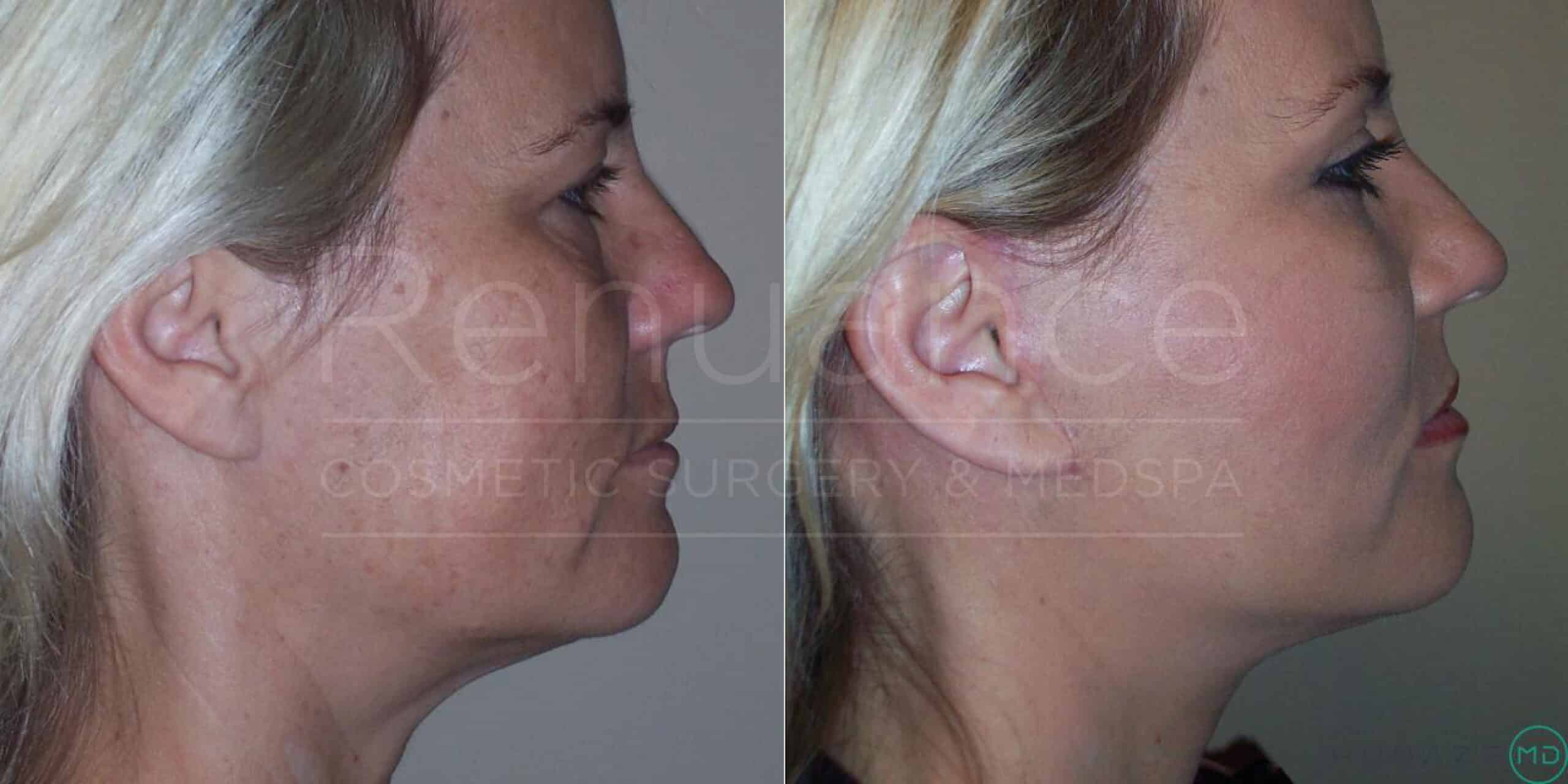 Side-by-side comparison image showing the profile of a woman's face before (left) and after (right) a cosmetic surgical procedure. The woman appears to have reduced facial sagging and improved skin tightness in the "after" image. The background is neutral, putting focus on the differences in the facial contours.