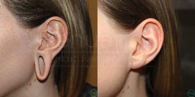 earlobe repair surgery with earlobe reduction before and after