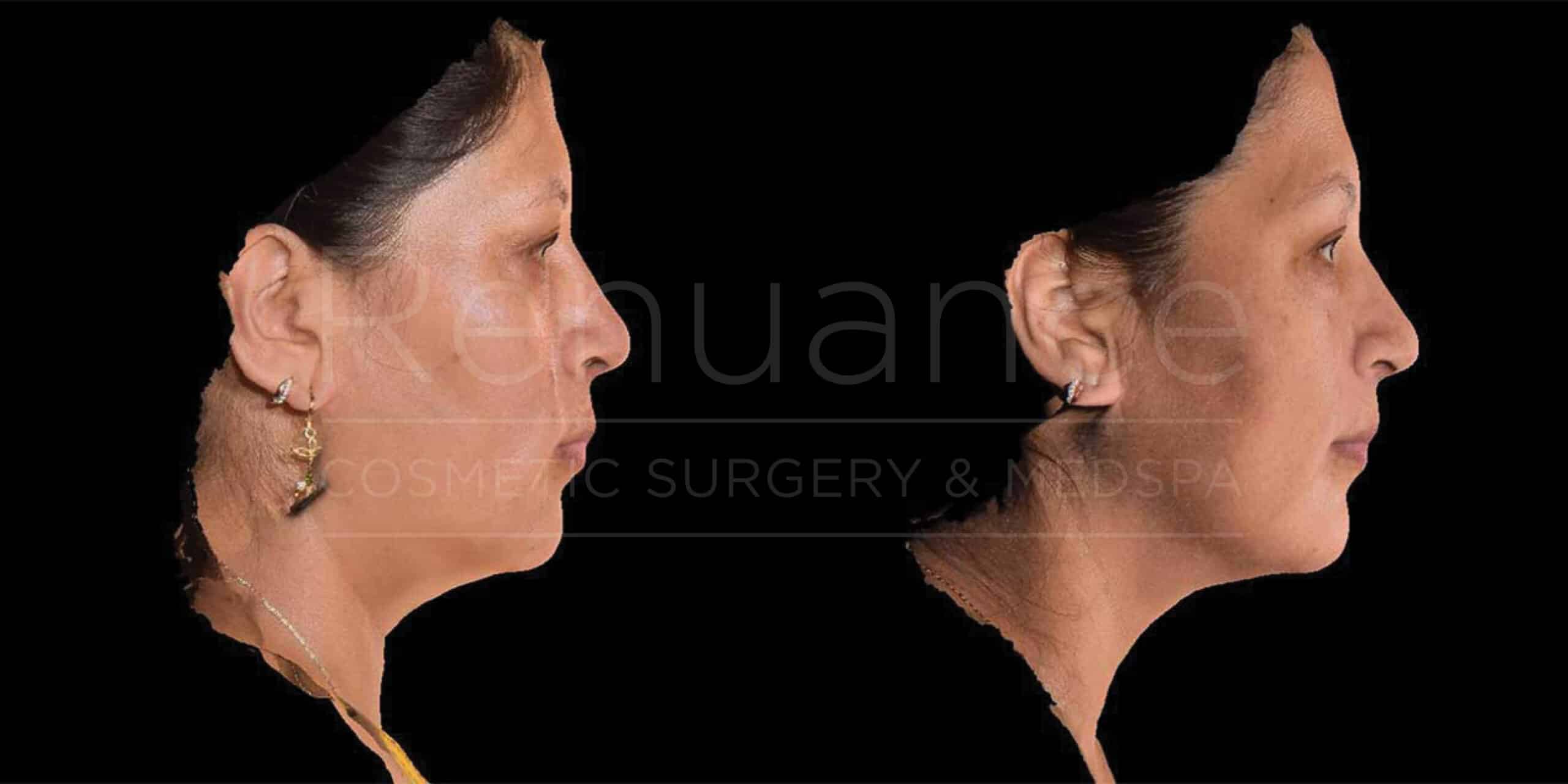 Side-by-side profile images of a woman before and after a cosmetic procedure. In the "before" image, the woman has a more pronounced chin and jawline, while in the "after" image, her chin and jawline appear more refined and smoother. She wears earrings and a necklace in both images. The background is black.