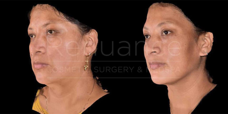 Side-by-side comparison images showcasing a woman's face before and after a cosmetic procedure. The left image shows her profile before the treatment, and the right image displays the after-effects. Both images illustrate changes in skin texture and contour.