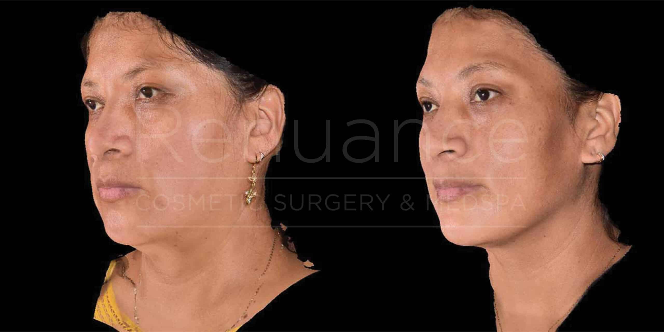 Side-by-side comparison images showcasing a woman's face before and after a cosmetic procedure. The left image shows her profile before the treatment, and the right image displays the after-effects. Both images illustrate changes in skin texture and contour.