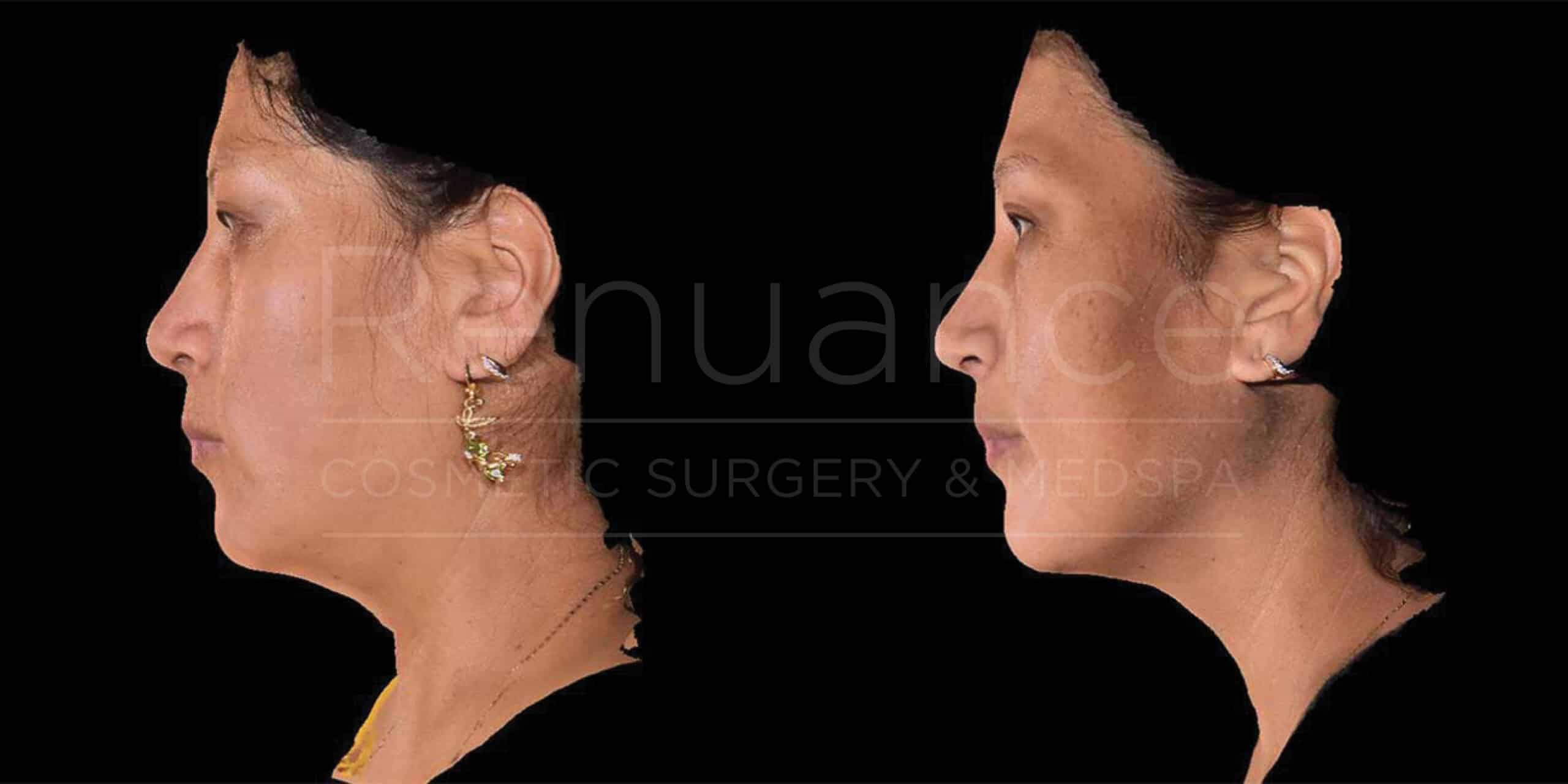Side-by-side images show a woman before and after cosmetic surgery. The "before" image on the left depicts a profile view of her face and neck with noticeable sagging. The "after" image on the right shows the same woman with a more defined jawline and tighter skin around her neck, indicating a successful cosmetic procedure. She is wearing earrings in both images, and the background is black.