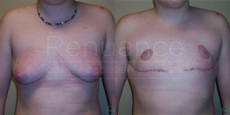 Before and after images of a person's torso following cosmetic surgery. The left image shows the individual's chest before surgery, with sagging skin and stretch marks visible. The right image shows the post-surgery result, with a flatter chest, surgical scars, and the removal of excess skin. The background contains text that is partially visible.