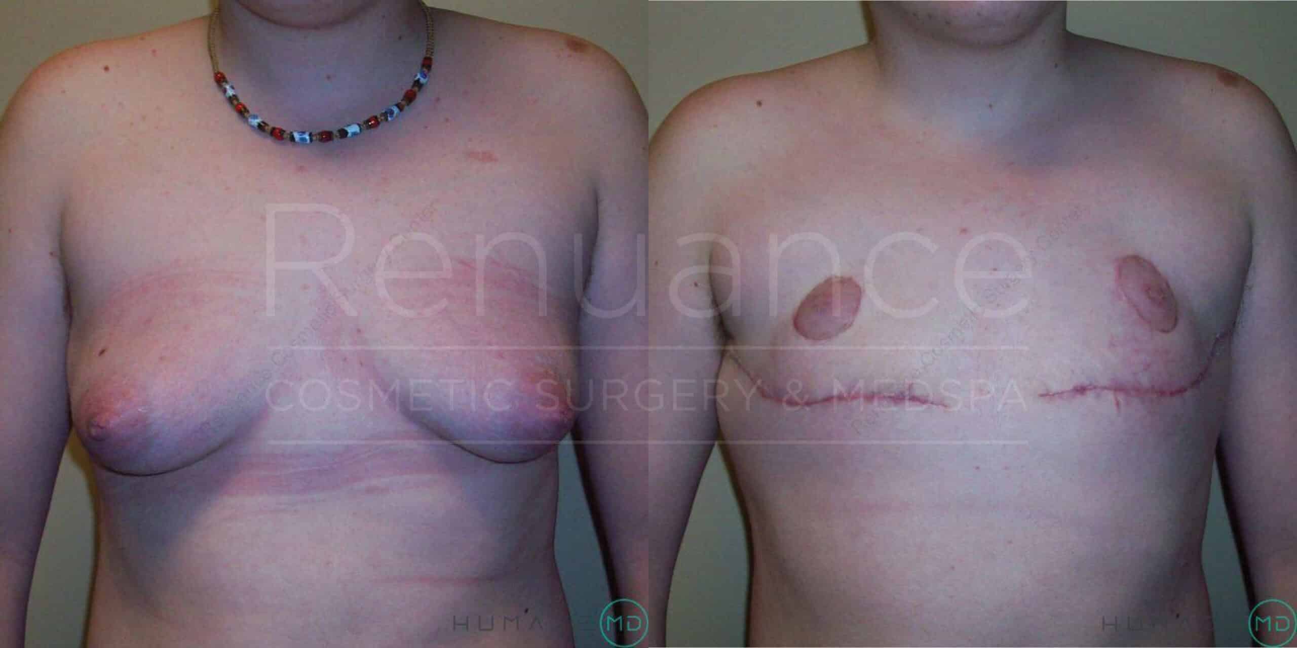 Before and after images of a person's torso following cosmetic surgery. The left image shows the individual's chest before surgery, with sagging skin and stretch marks visible. The right image shows the post-surgery result, with a flatter chest, surgical scars, and the removal of excess skin. The background contains text that is partially visible.