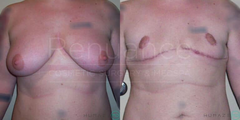 Before and after photos of a person's chest surgical procedure. The first image shows the chest before surgery, while the second image shows the chest after undergoing surgery, with visible scars and changes in appearance.
