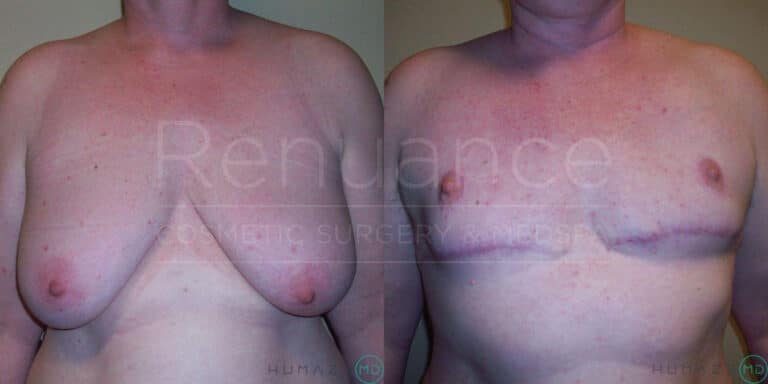 Side-by-side images of a person's upper body showing the results of breast reduction surgery. The left image is the "before" view, where the person's breasts are larger and sagging. The right image is the "after" view, where the person's breasts are smaller and more lifted. There are noticeable surgical scars under the breasts in the "after" image. The words "Renuance Cosmetic Surgery & Med Spa" are faintly visible over the images.