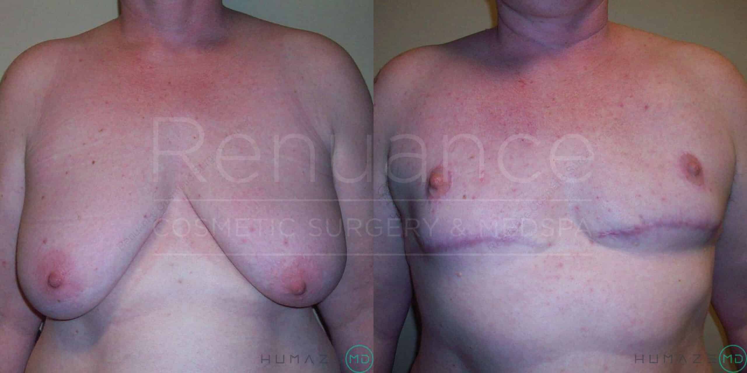 Side-by-side images of a person's upper body showing the results of breast reduction surgery. The left image is the "before" view, where the person's breasts are larger and sagging. The right image is the "after" view, where the person's breasts are smaller and more lifted. There are noticeable surgical scars under the breasts in the "after" image. The words "Renuance Cosmetic Surgery & Med Spa" are faintly visible over the images.