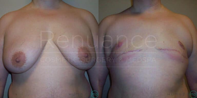 Side-by-side comparison image showing a person's chest before and after breast reduction surgery. The left side shows the chest before surgery, with larger breasts. The right side shows the chest after surgery, with significantly smaller breasts and visible surgical scars.