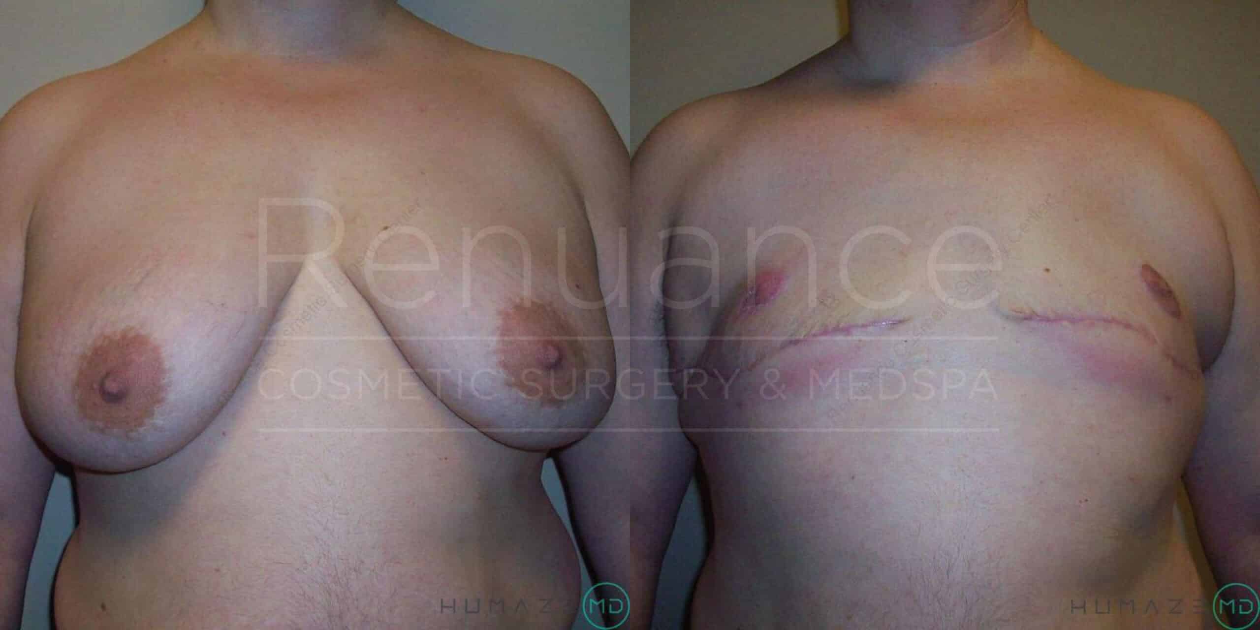 Side-by-side comparison image showing a person's chest before and after breast reduction surgery. The left side shows the chest before surgery, with larger breasts. The right side shows the chest after surgery, with significantly smaller breasts and visible surgical scars.