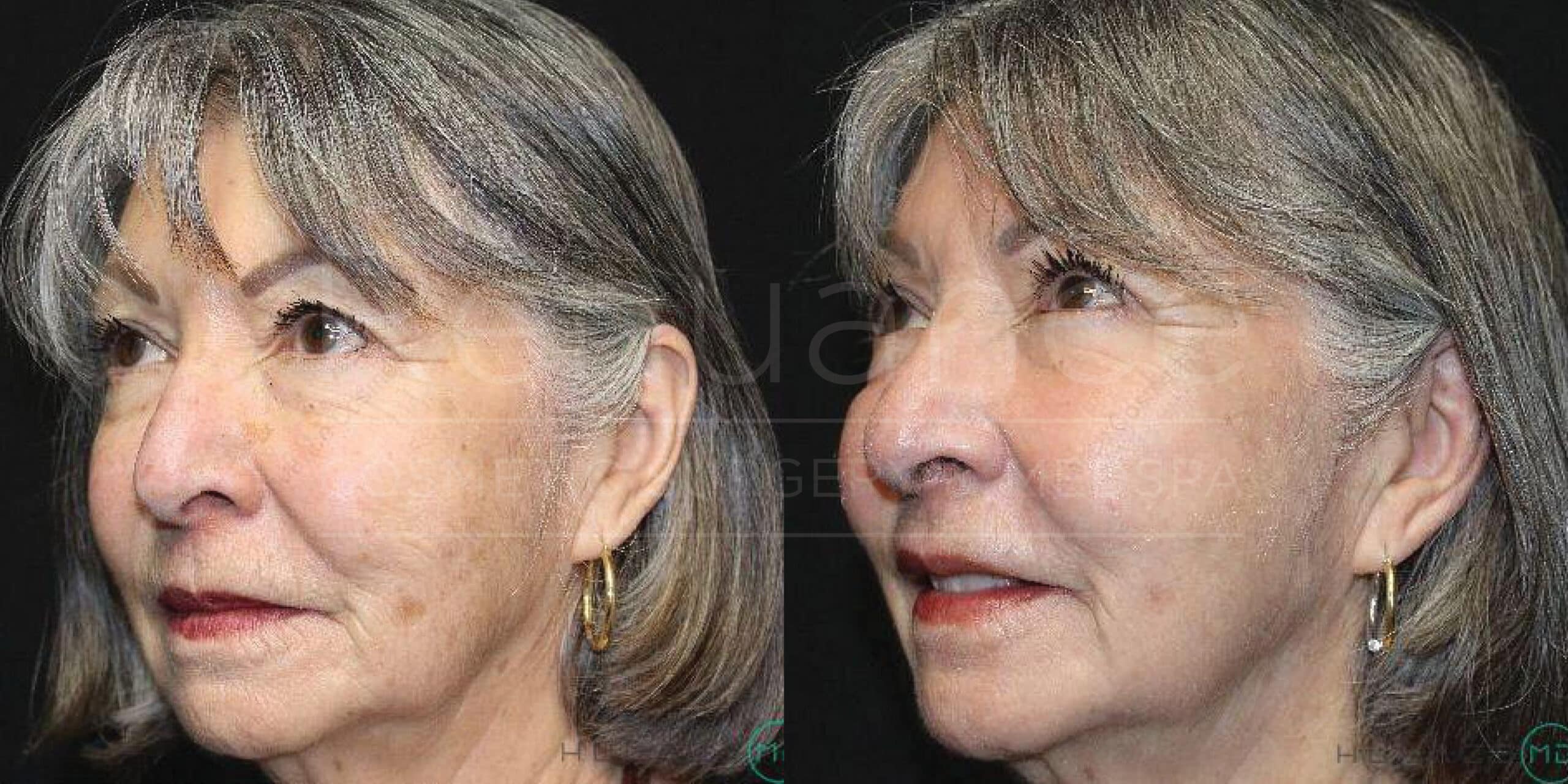 Side-by-side comparison images of an older woman before and after a cosmetic procedure. In both images, she has short gray hair and is wearing gold hoop earrings. The left image shows her face with more pronounced wrinkles and skin discolorations. The right image shows her with smoother skin, fewer wrinkles, and reduced skin discoloration. Both images are set against a black background.