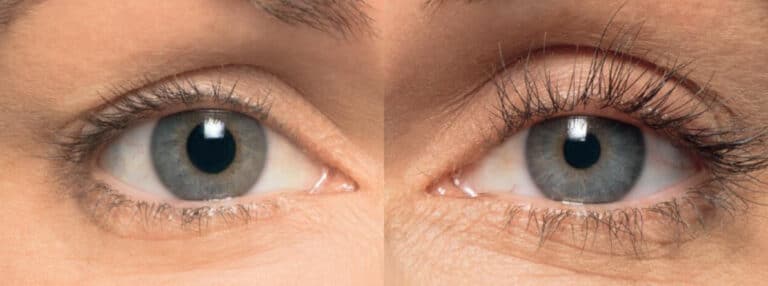 Close-up images of a person's eye before and after a cosmetic procedure. The left image shows the eye before the procedure, and the right image shows the eye after. The after image appears to have longer and more defined eyelashes.
