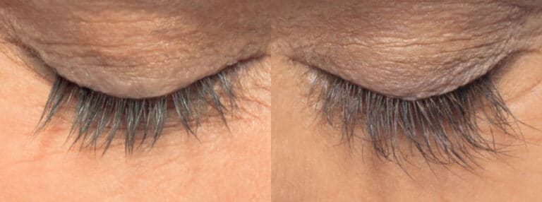 A close-up of two eyes closed, showing a comparison of eyelashes. The eyelash length on the left appears shorter and less dense compared to the eyelashes on the right, which appear longer and fuller. The skin around the eyes has visible texture and wrinkles.