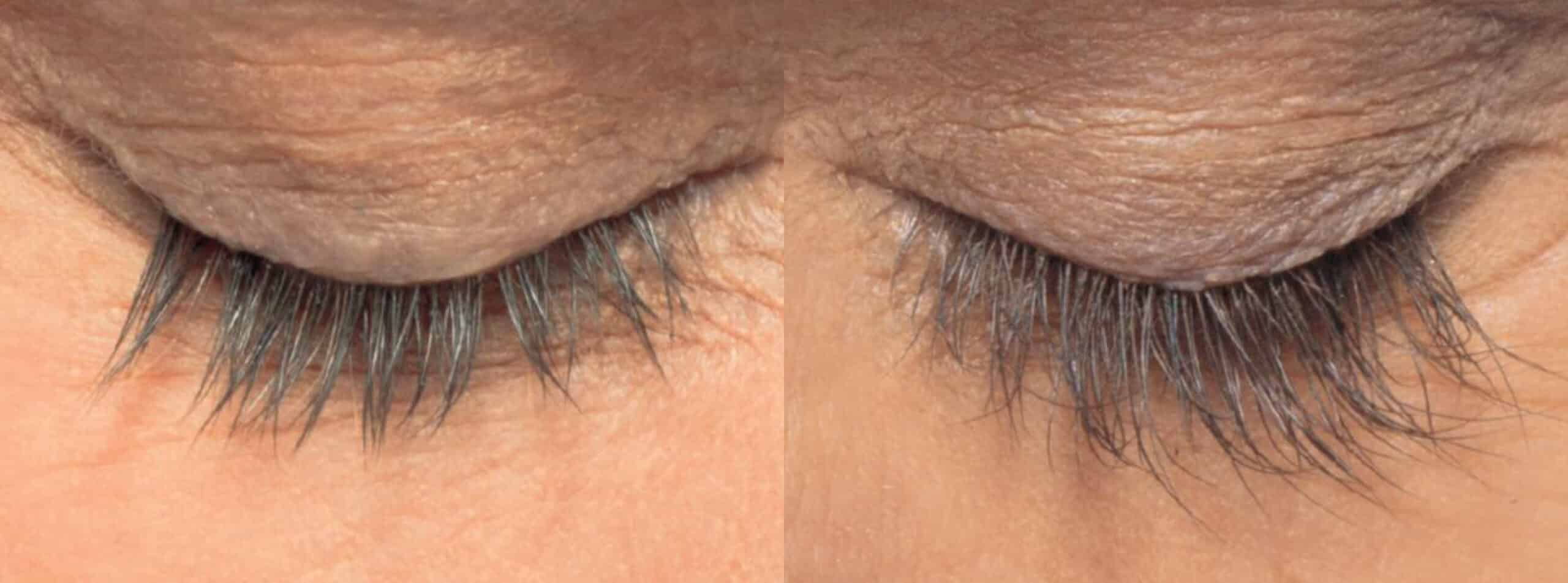 A close-up of two eyes closed, showing a comparison of eyelashes. The eyelash length on the left appears shorter and less dense compared to the eyelashes on the right, which appear longer and fuller. The skin around the eyes has visible texture and wrinkles.