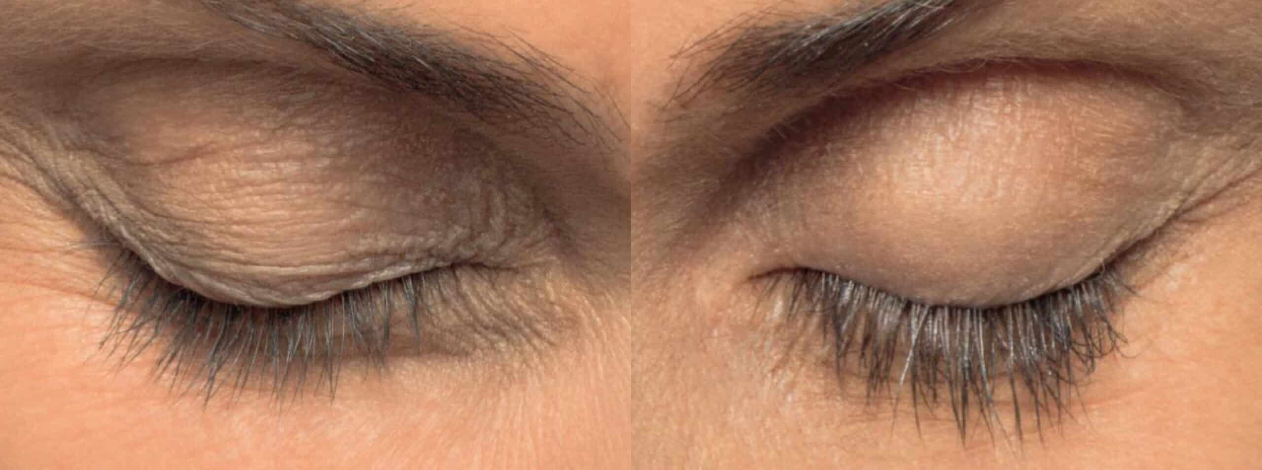 Close-up of two closed eyes, showcasing wrinkles and fine lines on the eyelids and surrounding skin. The image highlights the texture and appearance of the skin with variations in smoothness and wrinkles.