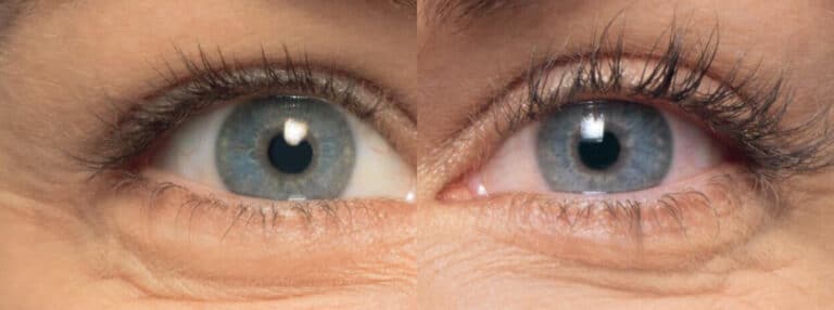 Close-up image showing a comparison of two eyes. The left side of the image depicts an eye with noticeable wrinkles around it, while the right side of the image shows an eye with fewer wrinkles, suggesting a possible demonstration of a before-and-after effect, potentially from a cosmetic treatment or skincare product. Both eyes have blue irises and similar lighting.