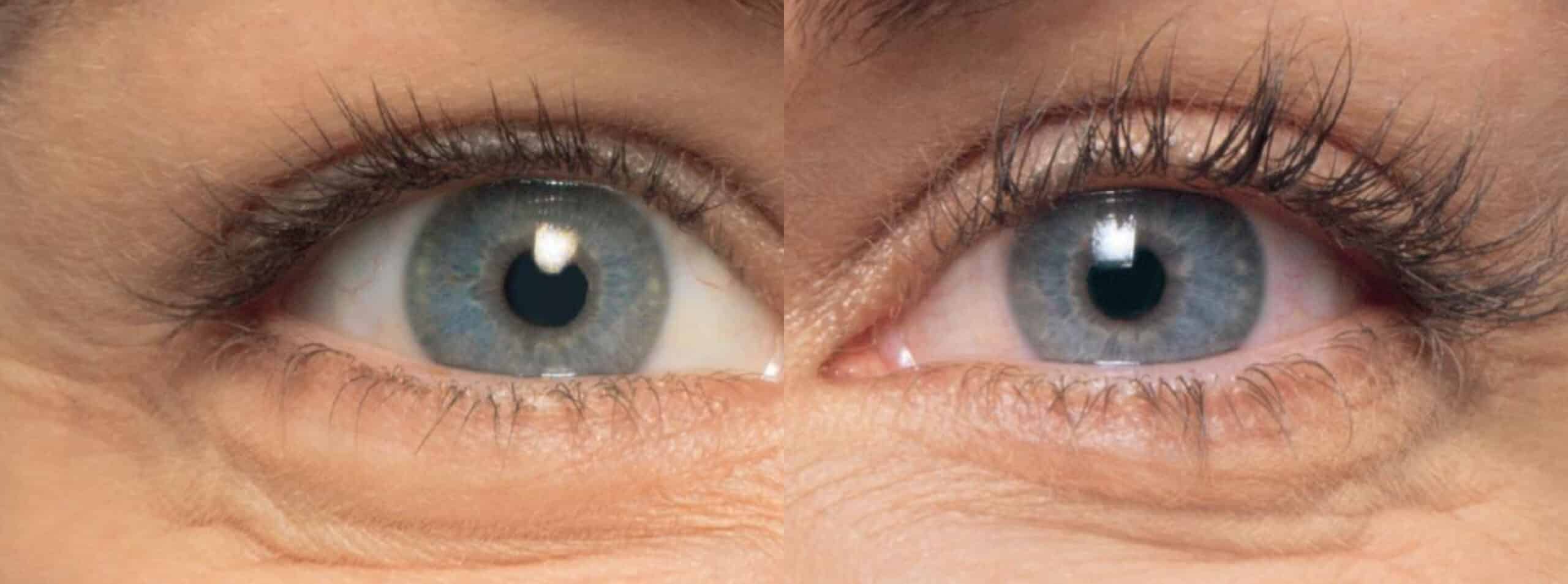 Close-up image showing a comparison of two eyes. The left side of the image depicts an eye with noticeable wrinkles around it, while the right side of the image shows an eye with fewer wrinkles, suggesting a possible demonstration of a before-and-after effect, potentially from a cosmetic treatment or skincare product. Both eyes have blue irises and similar lighting.