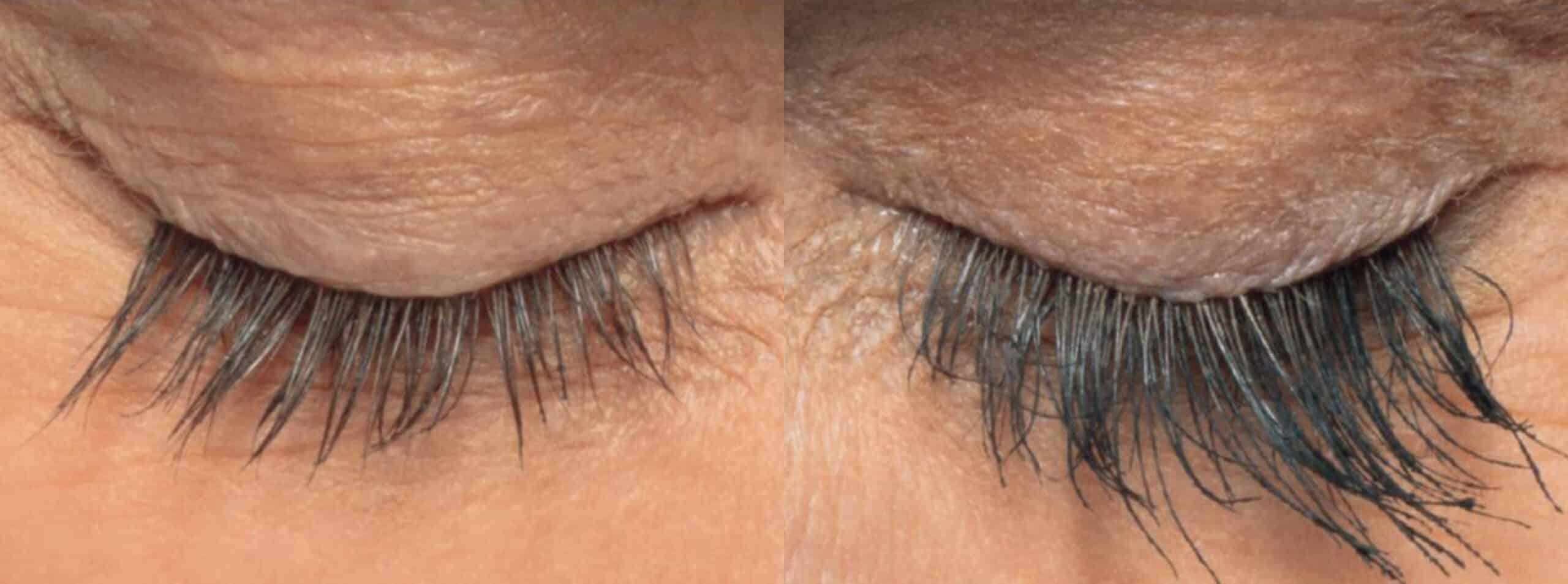 Close-up comparison of two closed eyes, showcasing the effects of an eyelash growth product. The image on the left shows shorter, sparse eyelashes, while the image on the right depicts longer, more voluminous eyelashes.