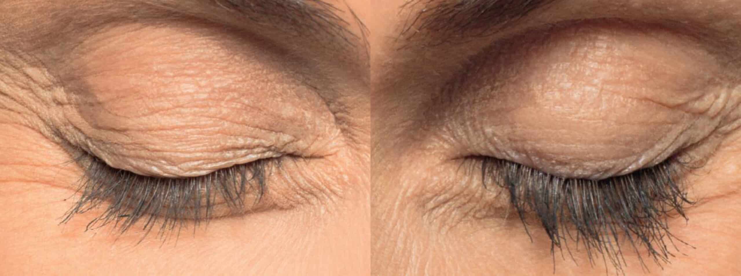 Close-up comparison of an eyelid area before and after skin treatment. The image on the left shows an eyelid with prominent wrinkles and fine lines. The image on the right shows the same eyelid with significantly reduced wrinkles and smoother skin texture.