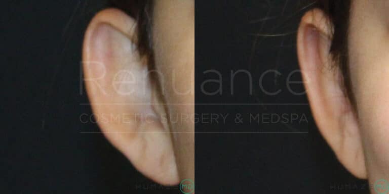 Side-by-side images showing ears before and after a cosmetic procedure. The image on the left depicts an ear with a slightly protruding appearance, while the image on the right shows the same ear with a more refined and closer-to-the-head contour. The background is dark, and the branding "Rejuance Cosmetic Surgery & Medspa" is faintly visible across the images.