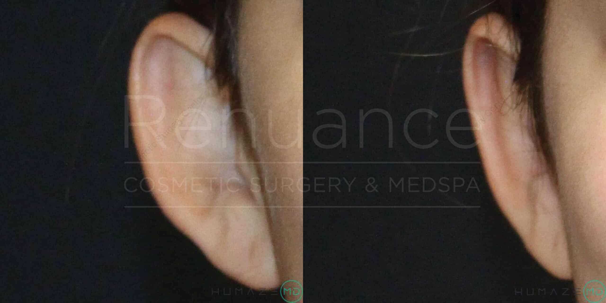 Side-by-side images showing ears before and after a cosmetic procedure. The image on the left depicts an ear with a slightly protruding appearance, while the image on the right shows the same ear with a more refined and closer-to-the-head contour. The background is dark, and the branding "Rejuance Cosmetic Surgery & Medspa" is faintly visible across the images.