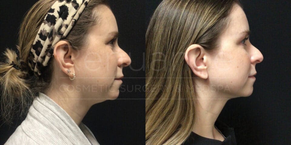 Side-by-side comparison of two profile images of a woman before and after undergoing a cosmetic procedure. The "before" image on the left depicts the woman with a thicker neck and double chin, while the "after" image on the right shows a more defined chin and slimmer neck. The woman wears a patterned headband and a light-colored top in the "before" image and a dark top in the "after" image. The background is black in both images.