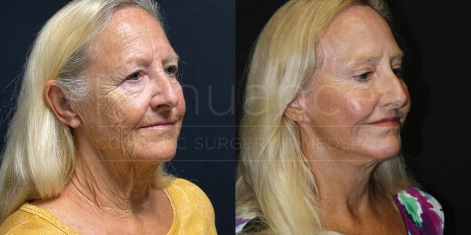 Before and After Facelift Necklift Brow Lift Fat Transfer Quad Blepharoplasty Co2 Laser by Dr. Hill