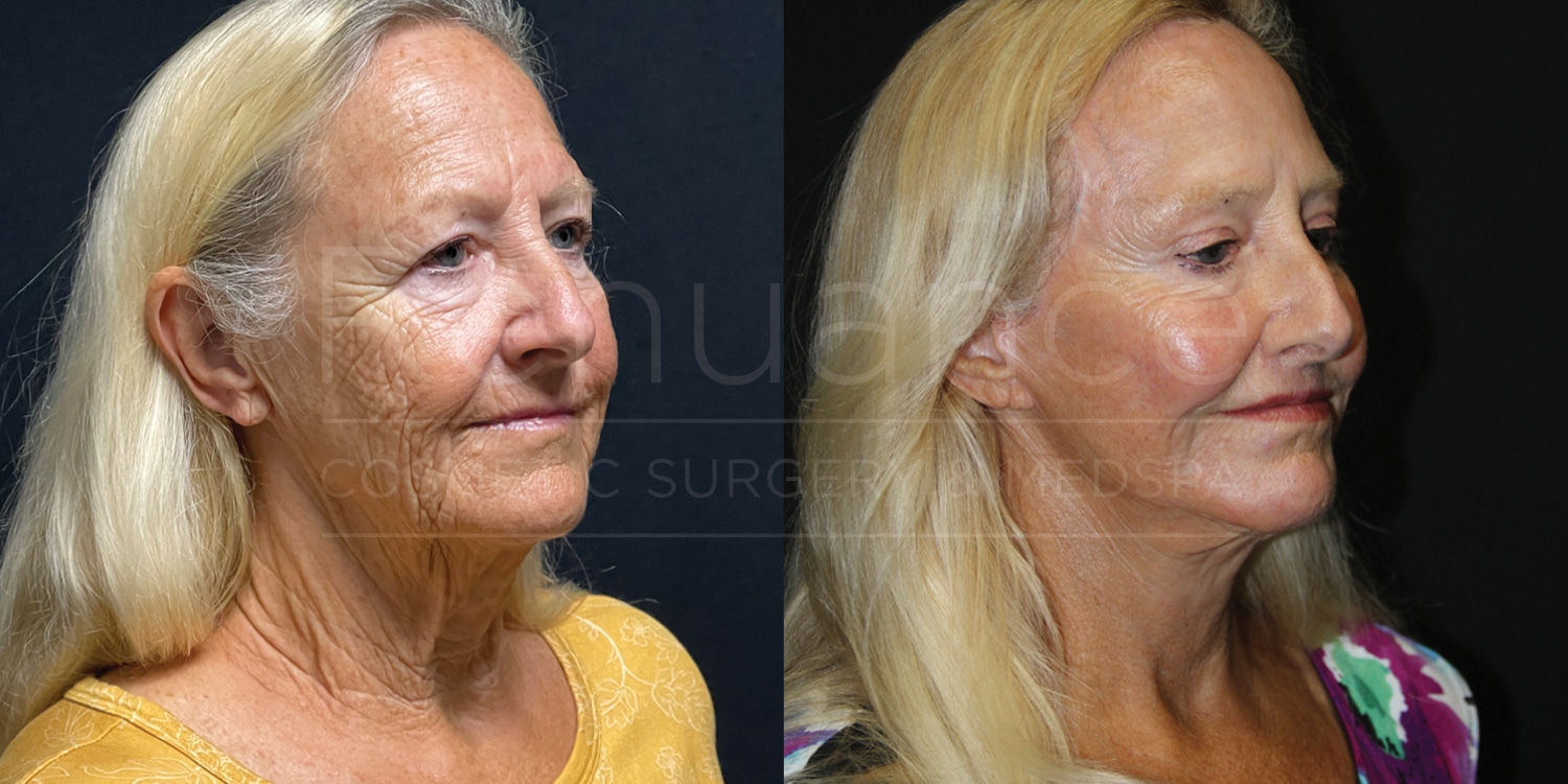 Before and After Facelift Necklift Brow Lift Fat Transfer Quad Blepharoplasty Co2 Laser by Dr. Hill